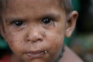 Guerras silenciosas: El hambre que mata millones de niños